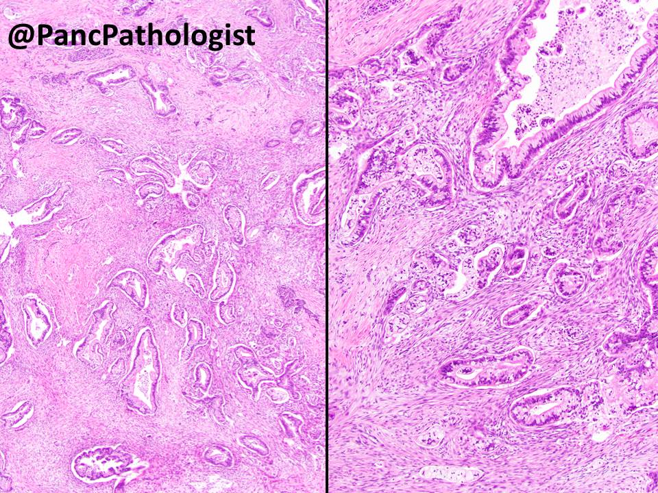 PancPathologist tweet picture