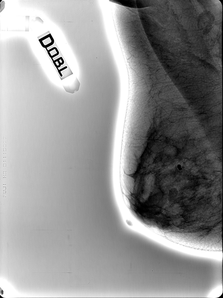 breast_imaging's tweet photo. #postproceso selectivo en #mamografia: Crestas de Duret
#mammography selective #postprocessing: Crests of Duret https://t.co/QlpdE2vdxx