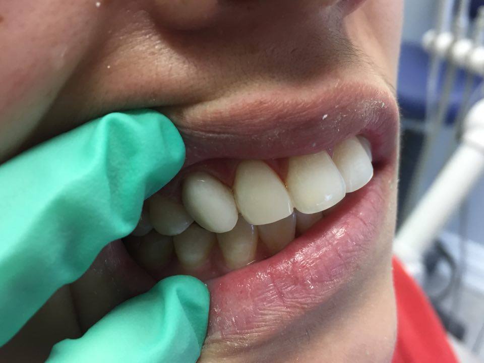 DWDENTALARTS's tweet photo. The art and science of dentistry. #veneers #contouring #whitening #smile #cosmeticdentistry https://t.co/pXEzwlZb67