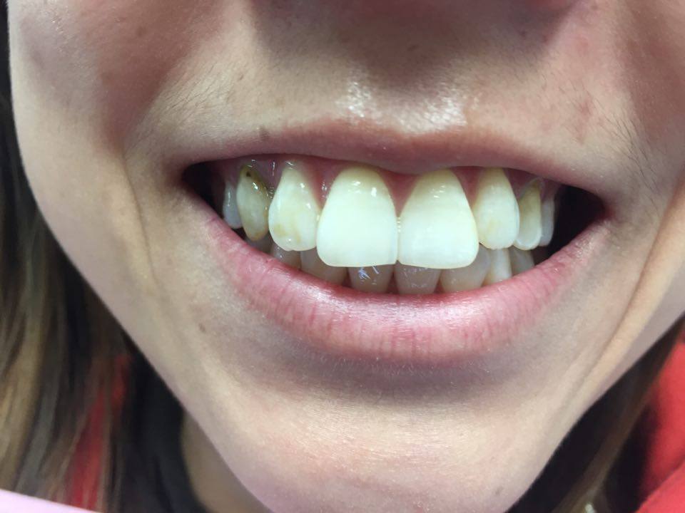 DWDENTALARTS's tweet photo. A little bit of tweaking makes a big difference. #veneers #feminization #contouring #dental #CosmeticSurgery https://t.co/xRzrRZsTnI