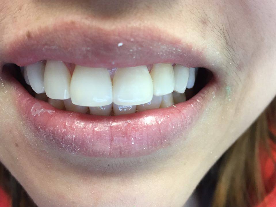 DWDENTALARTS's tweet photo. A little bit of tweaking makes a big difference. #veneers #feminization #contouring #dental #CosmeticSurgery https://t.co/xRzrRZsTnI