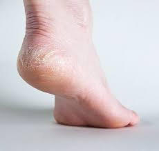 Suffer from dry heels? Try out a few of these Top 10 remedies for relief ht.ly/zLOa307iJKU !