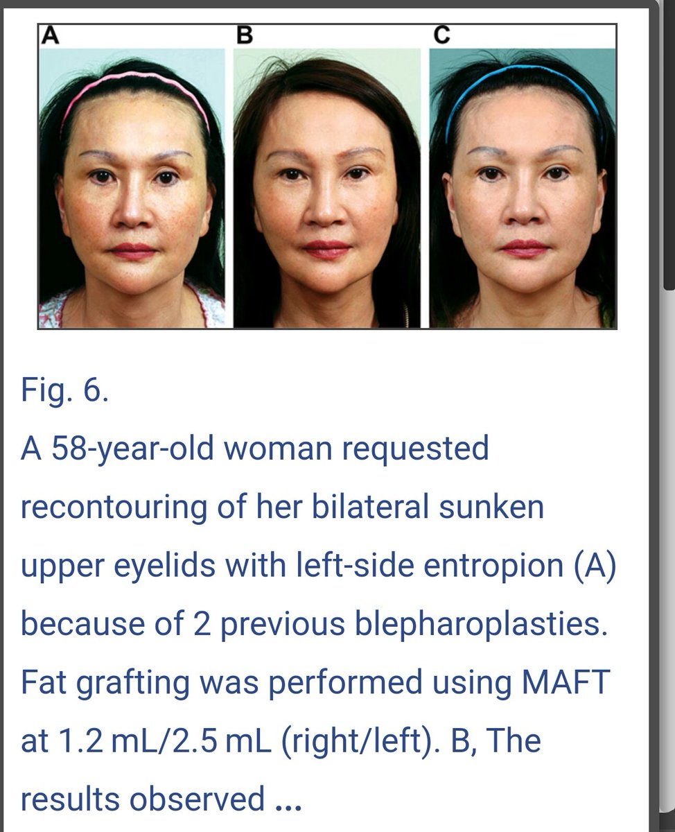 MaftGun's tweet photo. #Reconstructivesurgery
#PRSGO
#SunkenUpperEyelid
#MAFTGUN
#prsjournal
@prsjournal
https://t.co/hLxs6jkJXj https://t.co/RxxbPiJ8a0 https://t.co/CQmuF1MSkm