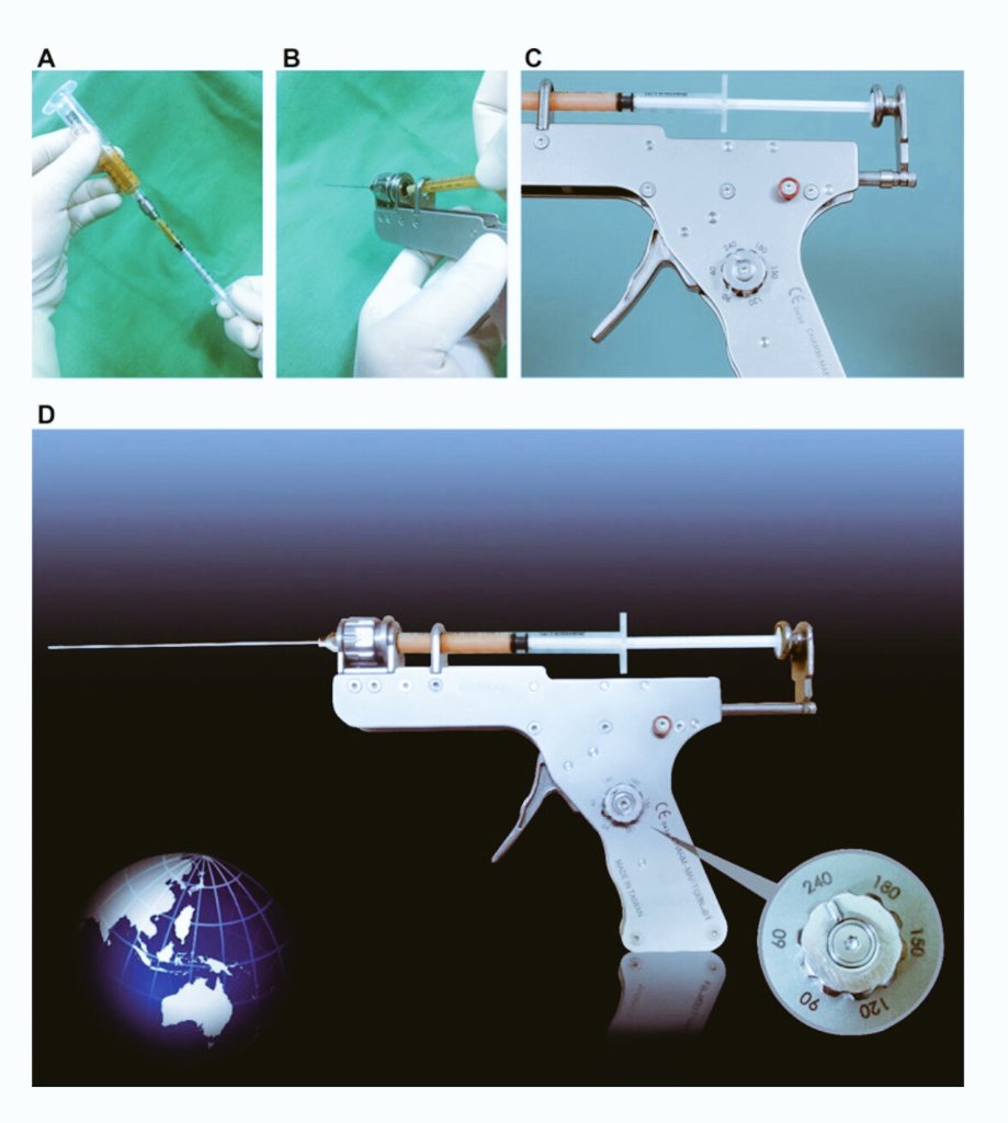 MaftGun's tweet photo. #Reconstructivesurgery
#PRSGO
#SunkenUpperEyelid
#MAFTGUN
#prsjournal
@prsjournal
https://t.co/hLxs6jkJXj https://t.co/RxxbPiJ8a0 https://t.co/CQmuF1MSkm