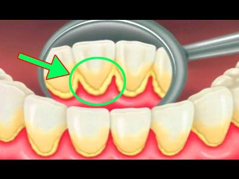 treatmentherbs's tweet photo. How To Remove Dental Plaque In 5 Minutes Naturally - Without Going To The Dentist ! Try This Now ! - https://t.co/wklMOOTLtw https://t.co/8GPTAb1HM0