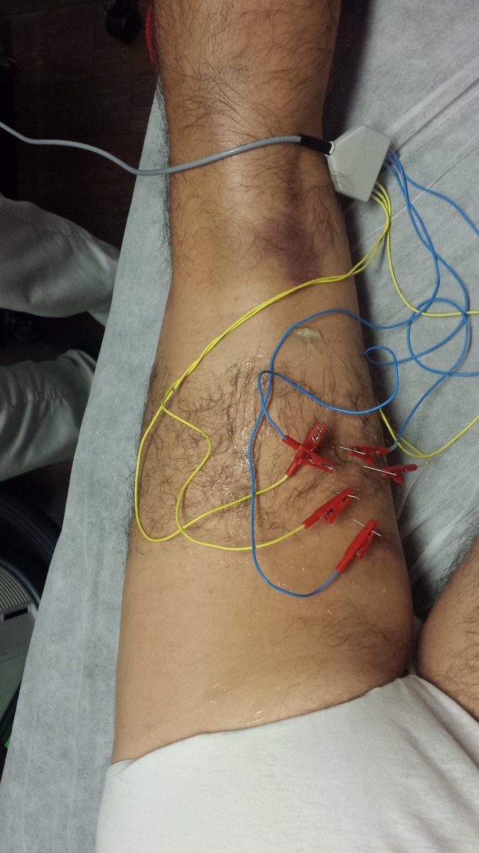 Un poco de #microcorrientes para mejorar esas roturas de fibras luego #Tcare #benditopadel #benditorunning #benditocrossfit <a href="/fisiojreig/">fisiojreig</a>