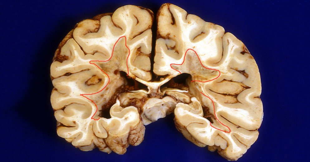 UCSF's tweet photo. Positive #multiplesclerosis clinical trial results support new treatment approach https://t.co/vr1ReAD8qi https://t.co/SFJ4LLbpVl