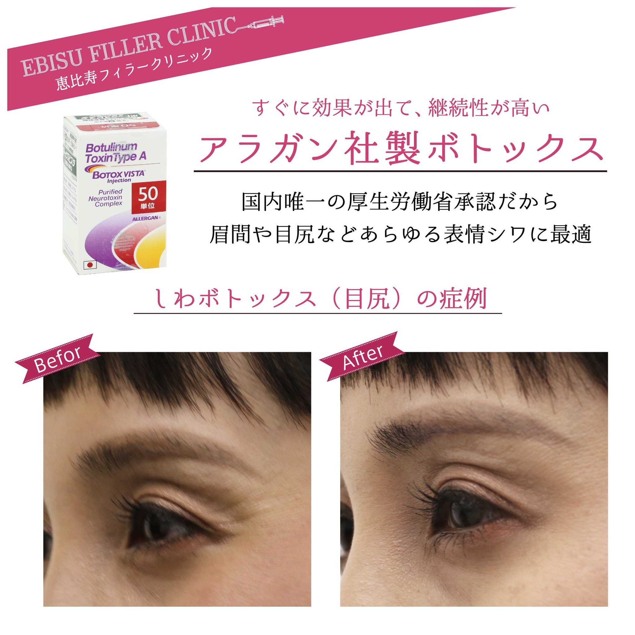 フィラークリニック 公式 Sur Twitter 目尻や目元は 他の皮膚と比べて薄いため シワがもっともできやすい場所 シワ対策には ボトックス注射がオススメ 写真は目尻にボトックス注射をした患者様 シワが驚くほど改善 O ボトックス注射は目尻1回8500円 税