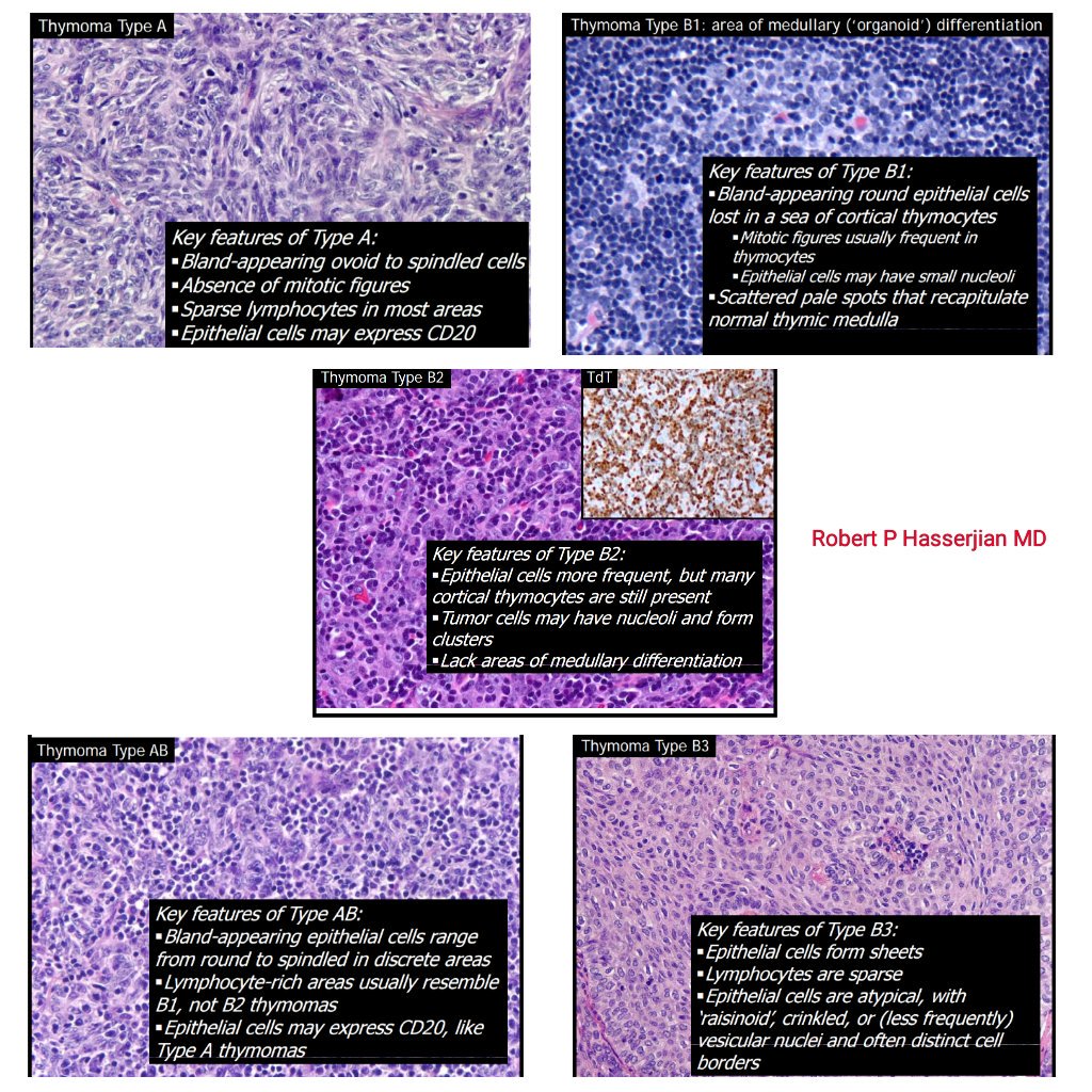 Thymoma review by Robert P Hasserjian MD. <a href="/kriyer68/">Kalyani Bambal</a> <a href="/pembeoltulu/">Pembe Oltulu, MD</a> <a href="/sam_albadri/">Sam Albadri, M.D., M.Sc.</a> <a href="/smlungpathguy/">Sanjay Mukhopadhyay</a> <a href="/suraksharaob/">Dr. Suraksha.Rao B</a> <a href="/NejibY/">Nejib Ben Yahia, MD</a> <a href="/raghupillappa/">Raghavendra Pillappa</a> <a href="/Missle/">Missle</a>