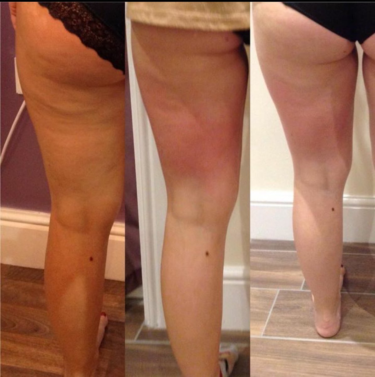 Excellent results with <a href="/3Dlipo/">3D-lipo</a> cellulite treatment,achieving inch loss and skin smoothing in just 8 sessions.