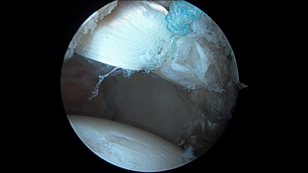 Irreparable labral tears can be successfully treated by labral reconstruction, using a graft to replace torn labrum. #HipArthroscopy