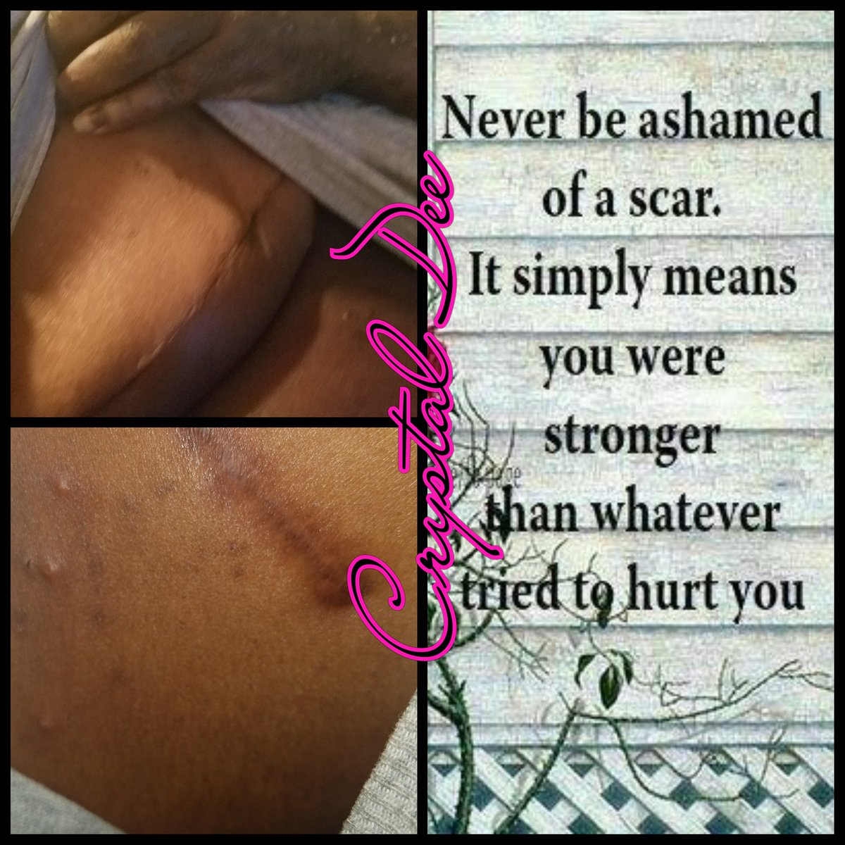 My scars are proof that God do heal and I'm victorious. #breastcancer #modifiedradicalmastectomy #portcath 
youtu.be/QUpTEfMaYzM