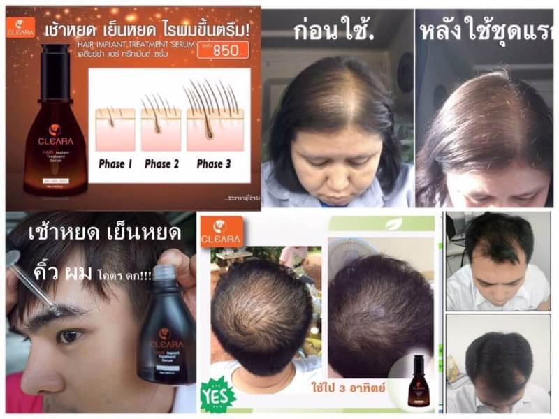 bankpewdee's tweet photo. เซรั่มปลูกผมที่ดีที่สุด ครับ ใครคิ้วบางอยากให้ค้วหนาก็ใช้ได้คับ #ผมบาง #คิ้ว #คิ้วดก #HowtoPerfect  #howtobeauty https://t.co/ikIuHF4t7W