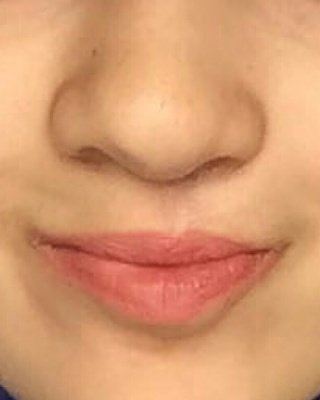 HygieiaTurkey's tweet photo. #lipcorrection #nosecorrection in #cleftlip #cleftpalate #yarıkdudak #yarıkdamak #dudak #noserevision #sekonderburun #rhinoplasty #gaumen https://t.co/eibEVMvi8B
