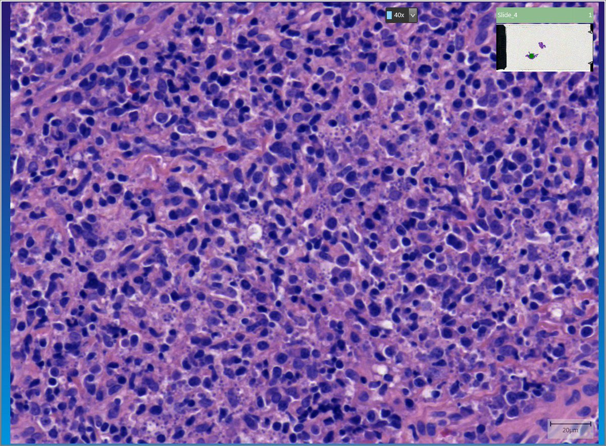 alfiaar1's tweet photo. #LYMPHPATH #LNPATH #NOTLYMPHOMA 
#PATHQA https://t.co/ILYl3EYr1e