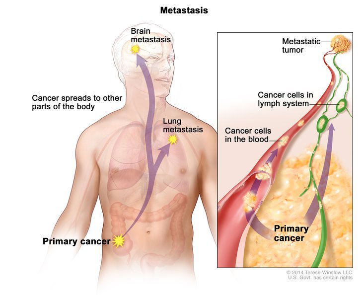 HealthyLife2017's tweet photo. How Cancer Spreads Through The Lymphatic System (And How To Keep It Healthy) https://t.co/t9uazNbZhR https://t.co/B8Y9gcM4a9