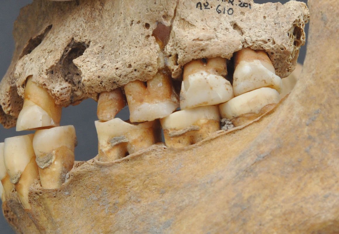 ana9ih's tweet photo. Descubren una prótesis dental hecha de dientes humanos en una tumba medieval https://t.co/tbx7p2Ydm1 https://t.co/yEmwfqXiLA