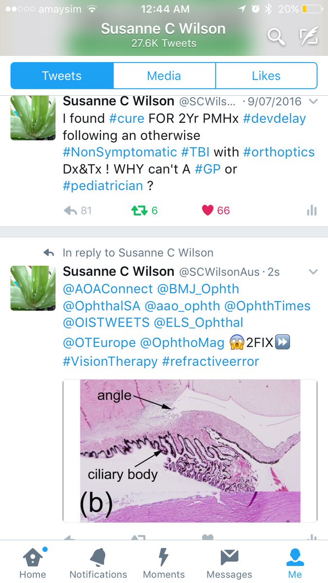 SCWilsonAus's tweet photo. 💔 #Ophthalmology #surgery #eyesurgery #LASIK ⏩banned - READ⏬article & think #piezoelectricffect #macroshock #microshock #htdrostaticshock 😡💔 https://t.co/J6xDoip8Vh