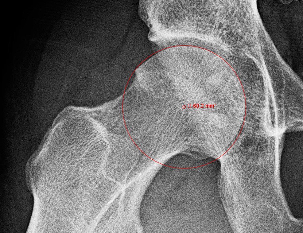 Most #HipArthroscopy surgeries should aim to improve the biomechanics of the hip, by changing the bony structure. Pre-post #HipFAI pics.
