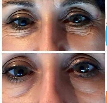 was für 1 Ergebnis nach nur wenigen Minuten😍 Die ultra effect eye patches sind der hammer! visione-cosmetics-shop.com #antiaging #COSMETICS