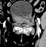 AlbanyIR's tweet photo. Pelvic trauma- active extrav- #getselective #irad @SIRRFS #withoutascalpel https://t.co/vZDosTJNwD
