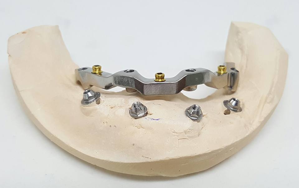 RheinDental's tweet photo. Bar supported by low profile threaded tiitanium Equator Attachments!
#implantology #dentistry #dental #laboratory #dentist #cadcam https://t.co/jIuQr68kPS