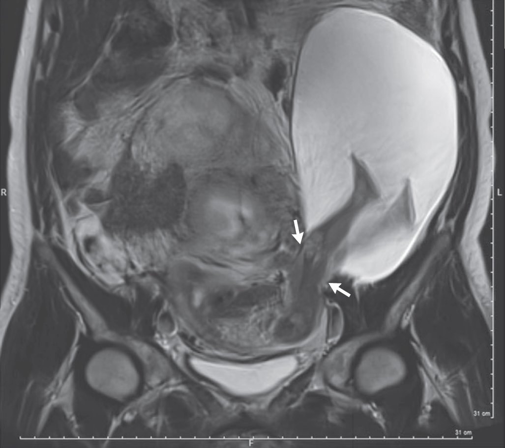 NEJM's tweet photo. MRI showing a 2.5-cm rupture of the left uterine wall and a large amniocele that contained fetal legs. https://t.co/Gx1E8akaQn https://t.co/ifXaxqA4lU