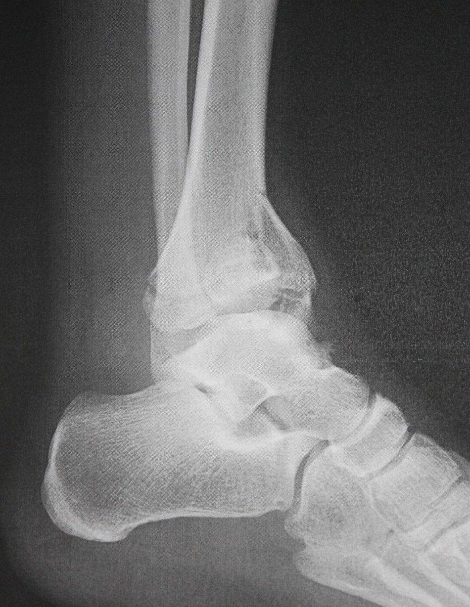 sportsfootankle's tweet photo. #Pilonfractures occur at the lower end of the #tibia and involve the weight-bearing surface of the #anklejoint https://t.co/d4Lxpa089c https://t.co/II2gMeTTyg