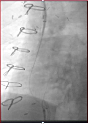 VIR_RUSH's tweet photo. Sharp venous recanalization of SVC w/ Rosch-Uchida needle for HERO placement. Where there's a vein there's a way! #irad #noRFwireNeeded https://t.co/MqS27rI91X