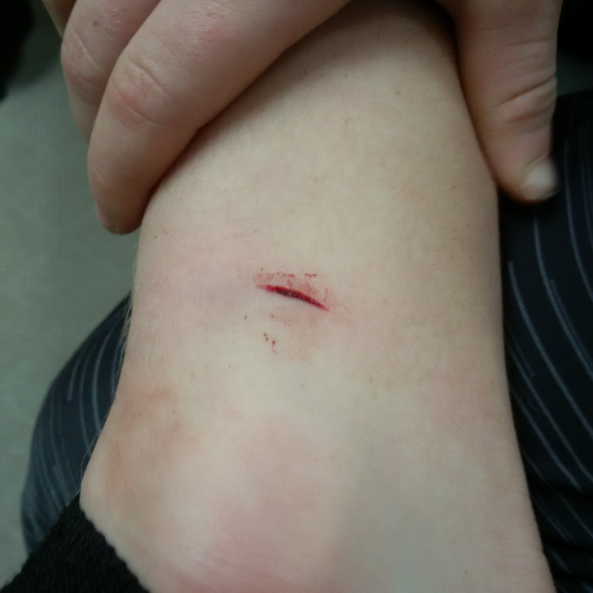 2007HPLakers's tweet photo. First one ice injury #chicksdigscars #deepcut #nostitches #trainermeddyalloverit https://t.co/7RYefMYhQz