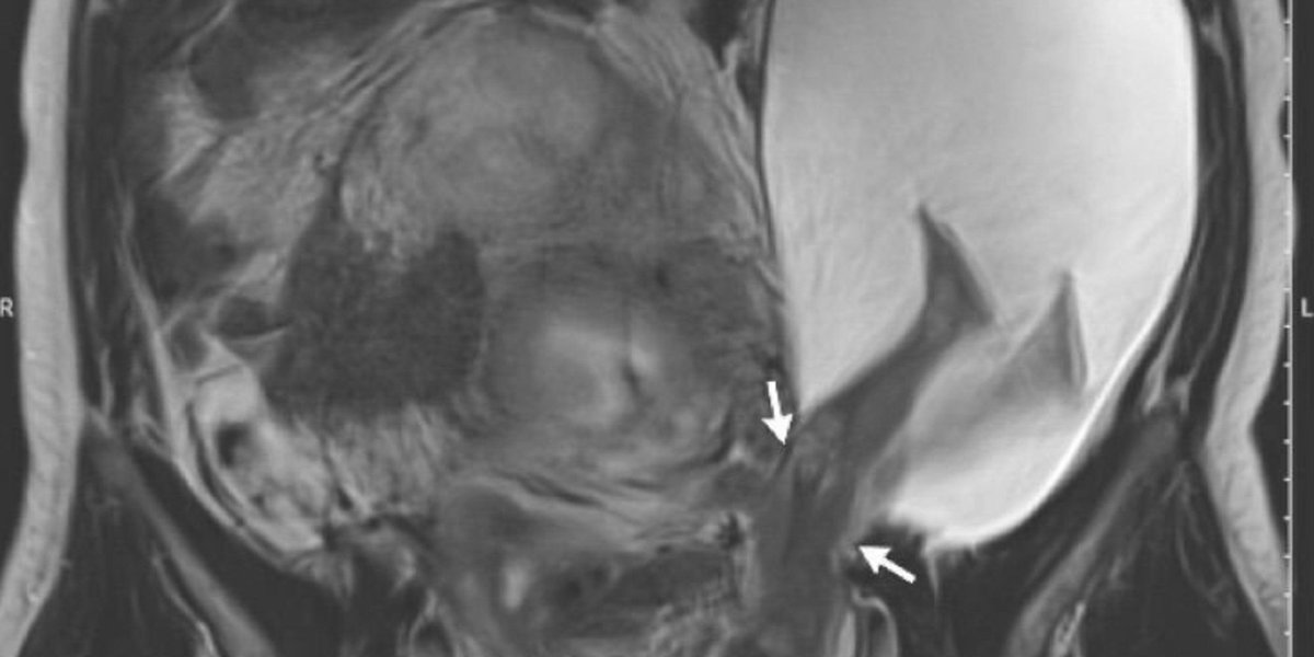 Extremely Rare Image Shows Unborn Baby’s Feet Growing Outside Uterus buff.ly/2hwJUzt? #preemie #NICU #parents #baby via
