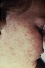 MDedgeDerm's tweet photo. Lab values poor surrogate for detecting pediatric Rocky Mountain #spottedfever in children. #Dermatology https://t.co/Uu2azITQFE https://t.co/HngbSIwpEe