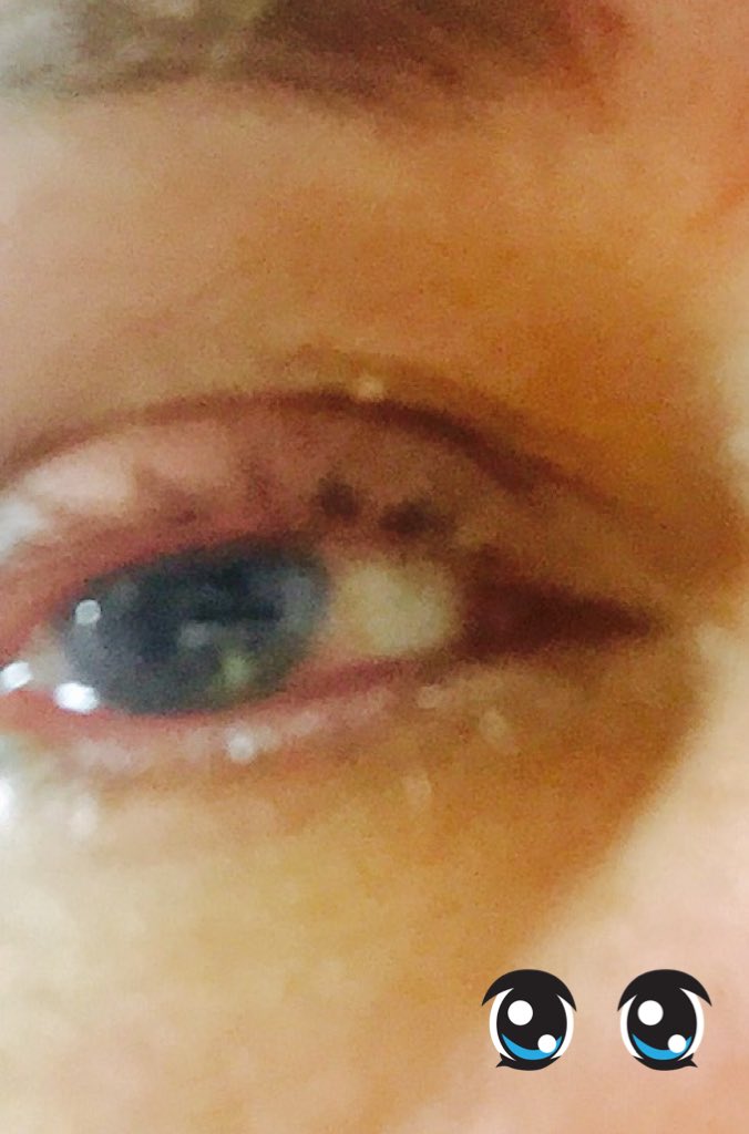 BellaDuceppe's tweet photo. Greffe de cornée fait par la meilleure médecin ### Dr Talajic https://t.co/ji6k3kGxmD