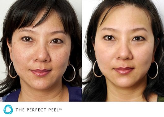 OC_Aesthetics's tweet photo. The #PerfectDerma™ #Peel is the only peel that includes #Glutathione, which #lightens &amp; #brightens the #skin to slow down the aging process. https://t.co/daPYXeKQIy