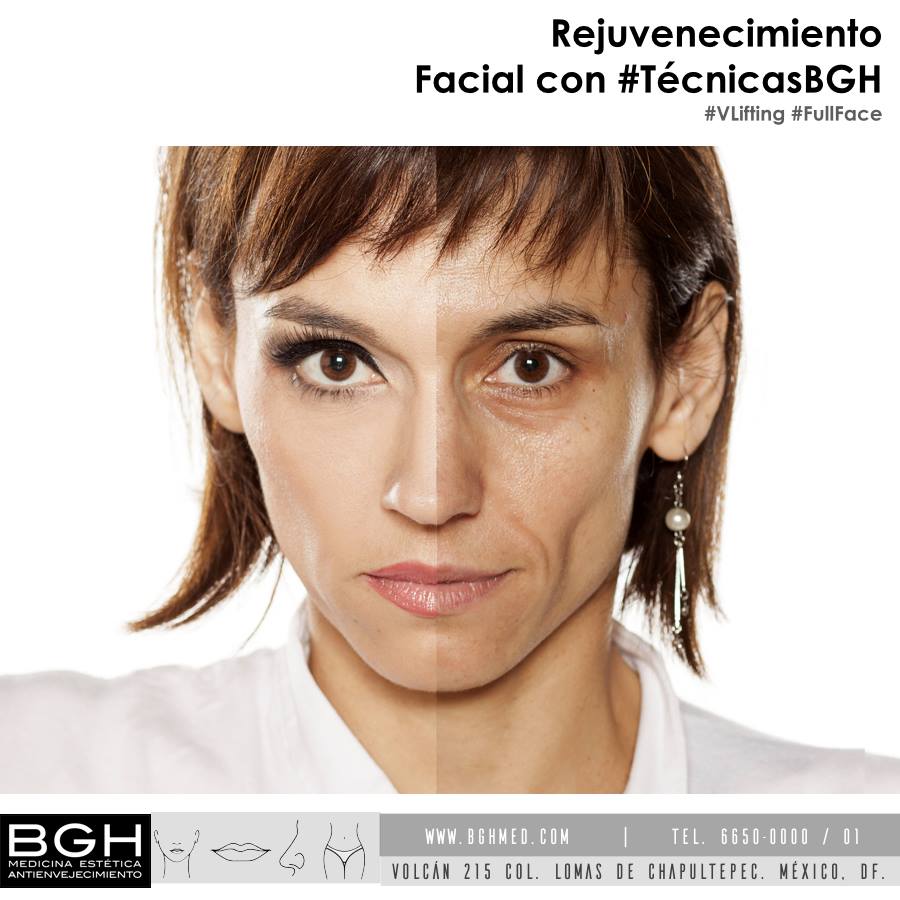 bghmedestetica's tweet photo. #Vlifting y #FullFace siguen siendo las técnicas consentidas de nuestros amigos y pacientes para el rejuvenecimiento facial #BGH https://t.co/kCjxaQDofd