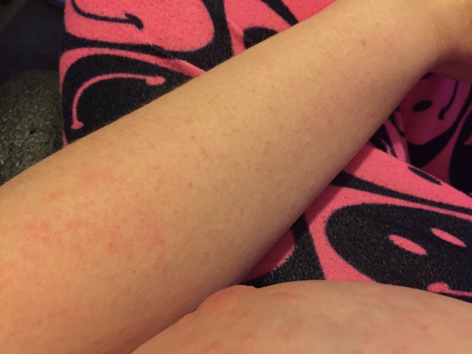This is my arm covered in whats all over my body which hurts and is itchy as hell! https://t.co/Q78f<a href="/tag/myfreecams"class="tags"><span>#myfreecams</span></a><a href="/tag/camgirl"class="tags"><span>#camgirl</span></a>