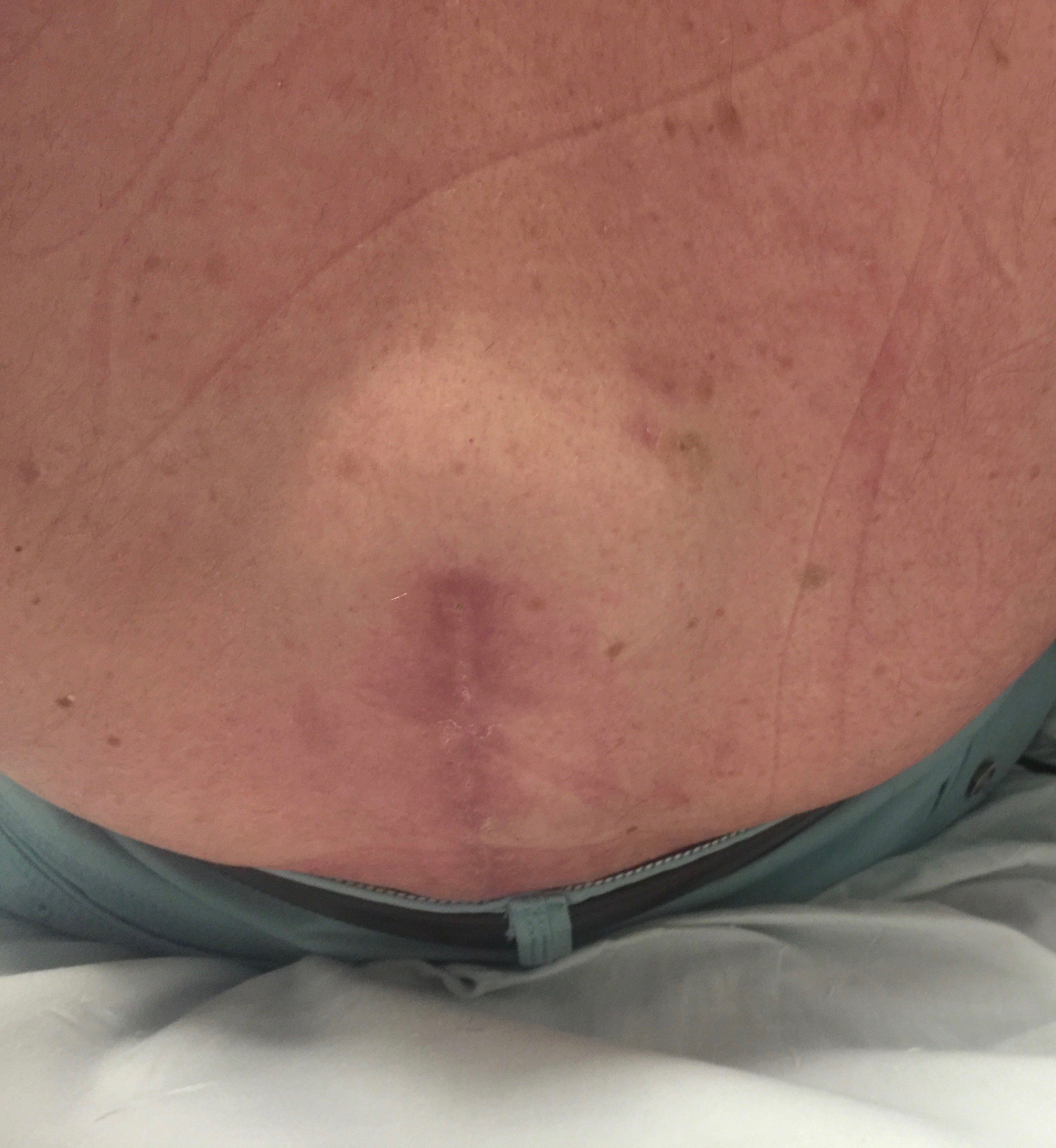 Ο Χρήστης Jenkins Neurospine Στο Twitter: &quot;If You Back Looks Like This After  Spinal Surgery, You May Have An Untreated Spinal Fluid Leak - It Can Even  Develop Days Or Weeks Later!