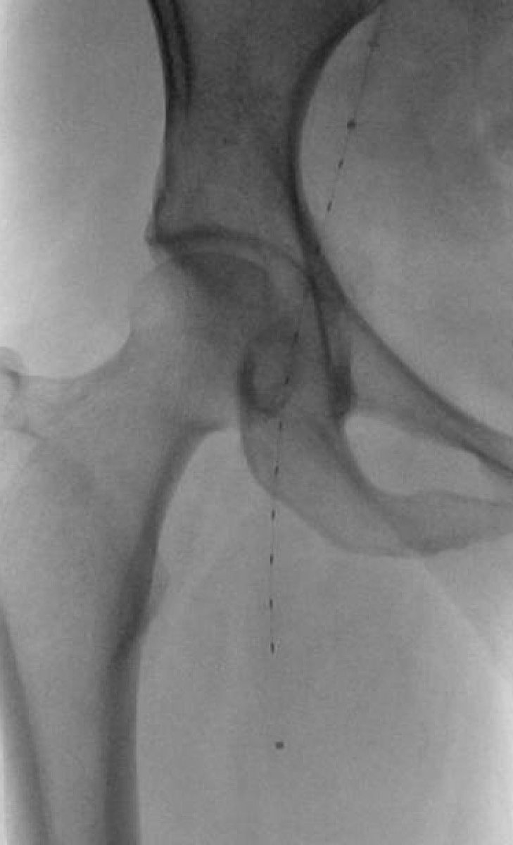 AlexCVIR's tweet photo. 52 yo F with Afib presenting with Rutherford 2a ALI. R CFA embolus treated with #EKOS thrombolysis. #IRad #MIIP #savealeg #PADawareness @BTG https://t.co/hXyL0m4R9e