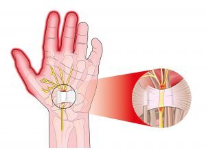carpal tunnel syndrome physiopedia)