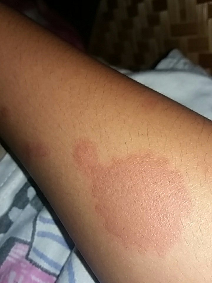 MpitAjaaaaa's tweet photo. Melepuh 😣 https://t.co/xJtdQNuRAw