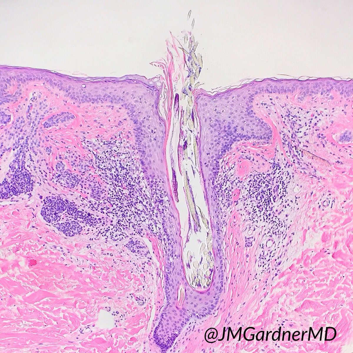 #Dermpath hashtag on Twitter