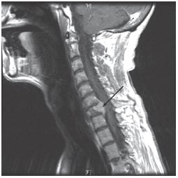 CNS_Update's tweet photo. Don't forget to attend the Advances in the Treatment of Metastatic Disease to the Spine webinar tonight at 7:30pm ET https://t.co/ED249DKrIh https://t.co/zO20gY3H5d