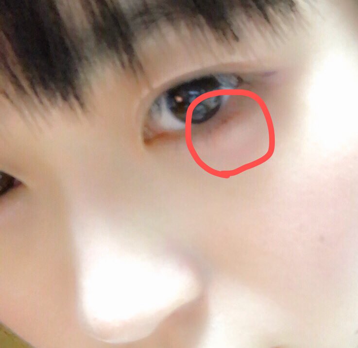 夜道 雪 على تويتر なんか目の下にモコっとしたできものできてる これなに 痛みはないんだけど とくに思い当たることないし 夕方はこんなのなかったから急にはれた 目も擦ってないし触ってないはず 誰かわかる T Co