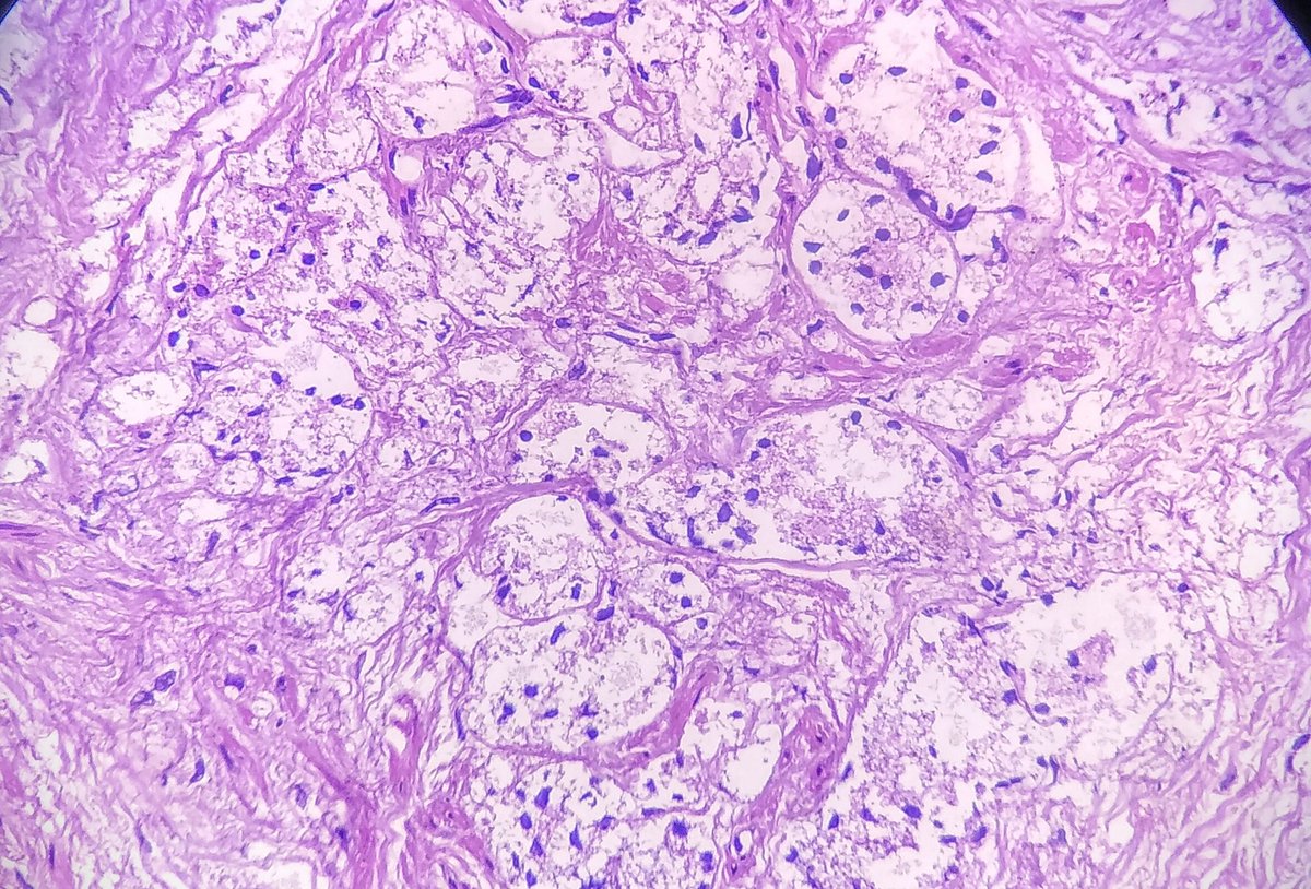 foamy gland adenocarcinoma prostata