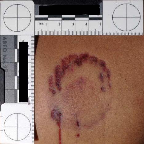 serial__killers's tweet photo. The bite mark that got Ted Bundy convicted #serial killers https://t.co/fkbwacmxfe