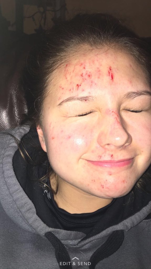 linneamayyy's tweet image. UPDATE: Already took an L by sledding :))) #firstdayof2017