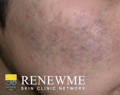 오타모반, 오타씨모반은 검회색을 띄는 색소질환으로 자연적으로는 사라지지 않습니다. 리뉴미피부과는 색소질환끝판왕 포토나레이저로 오타모반을 효과적으로 치료합니다. m.rnmeskin.com/clinic128/