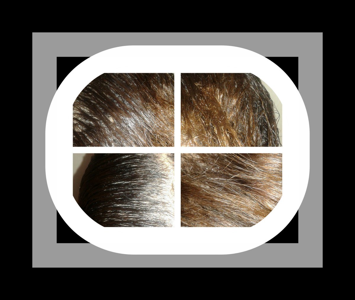 yesenia_case's tweet photo. El proceso del tratamiento de alopecia https://t.co/11u0E4MNmc