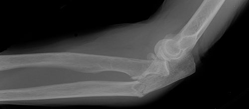 NorthwesternEM's tweet photo. What nerve deficit do you expect?
Find out at the Ortho Teaching File:
https://t.co/0PSSaF8XbD
#WhyNUEM? #FOAMed #inserviceprep https://t.co/AzDVcHp64g