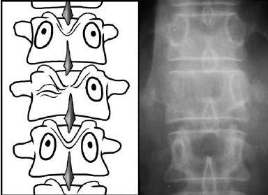 EM UofT on Twitter: "Winking owl sign on lumbar xray - think ...